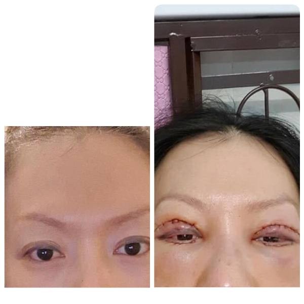 Thẩm mỹ ở cơ sở 'dỏm', đau đớn vì mắt không thể nhắm kín - ảnh 1