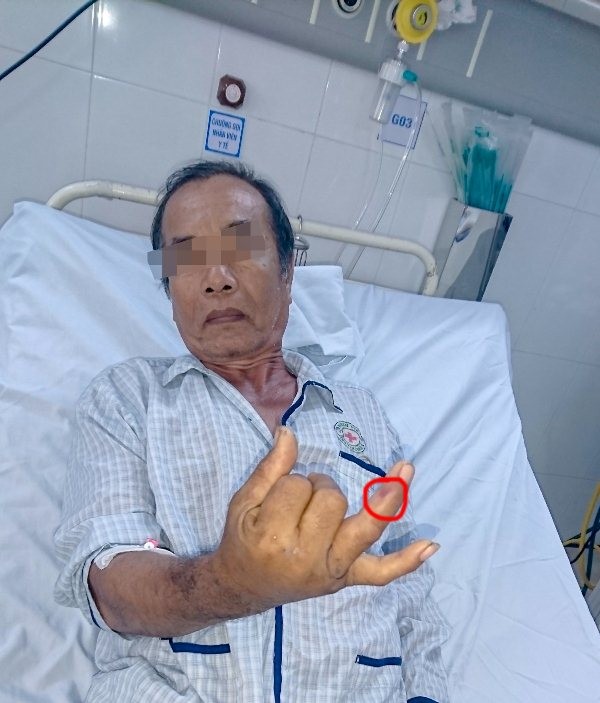 Nhiều người nhập viện do rắn lục đuôi đỏ cắn - ảnh 1