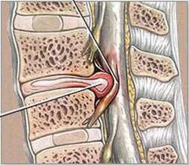 Gai cột sống- bệnh không được chủ quan - ảnh 1