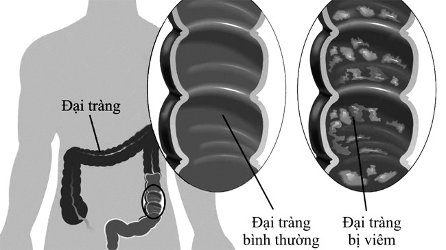 VIÊM ĐẠI TRÀNG - PHÒNG NGỪA VÀ ĐIỀU TRỊ - ảnh 1