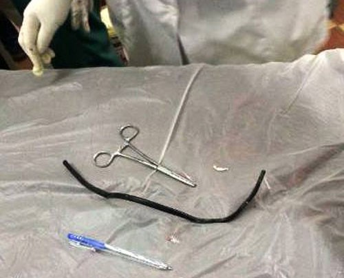 Lấy dây điện dài 40 cm nằm trong ruột người gần 2 năm - ảnh 1