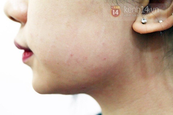 Tiêm xong trên mặt Hạt Mít vẫn còn những nốt đỏ, nhất là ở những vùng da mỏng. Nhưng ngay hôm sau cô có thể trang điểm bình thường và các nốt sẽ biến mất trong một tuần. Còn bây giờ chỉ phải chờ một tháng nữa để khuôn mặt nhỏ dần lại mà không cần đến phẫu thuật đau đớn