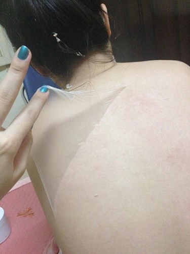 Chỉ vì ham làn da trắng mịn không tì vết rẻ tiền nhiều trường hợp phải nhập viện để giải quyết những hậu quả do tắm trắng gây ra, nhẹ thì bị dị ứng nổi mề đay, nặng hơn là suy hô hấp, phù tạng, rối loạn nhịp tim..
