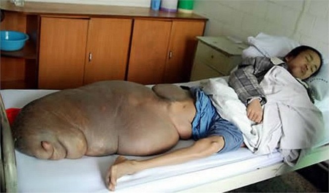Chen Zongtao, 29 tuổi, sống trong một ngôi làng hẻo lánh của Trung Quốc và không đủ tiền chi trả phí y tế nên đã để mặc cho khối u phát triển tới kích cỡ cực khủng và trọng lượng 70kg