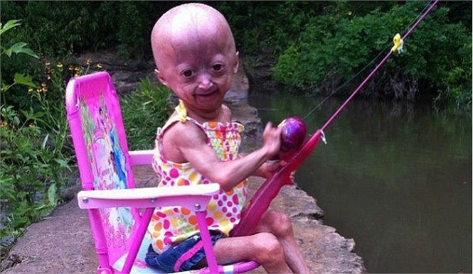 Căn bệnh của Rose có tên gọi là Progeria, một căn bệnh do rối loạn gien gây ra. Nhìn cơ thể của bé, không ai tin rằng, bé chỉ mới 6 tuổi