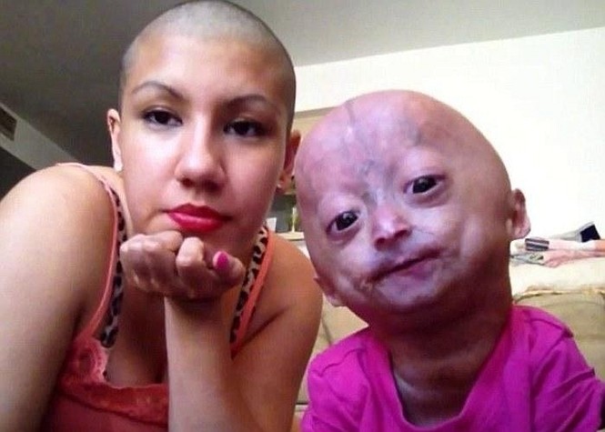 Bé Adalia Rose, 6 tuổi, người Mỹ, mắc một căn bệnh hiếm gặp, khiến cơ thể của bé trở nên già hơn so với tuổi