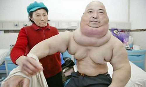 Huang Liqian nhận thấy biểu hiện bất thường trên cơ thể từ năm 1990, nhưng lại chủ quan cho qua. Kết quả là khối u có cơ hội phát triển tới 15kg. Rất may, khối u này đã được phẫu thuật cắt bỏ thành công năm 2007