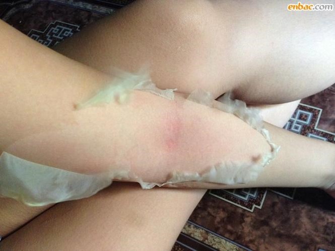 Các chuyên gia cho biết, việc lột da, tẩy trắng siêu tốc là trái với quy luật sinh lý tự nhiên của da, khi tiếp xúc với ánh nắng sẽ rất nguy hiểm vì lớp da ấy còn non, vừa dễ cháy đen da, vừa dễ bắt các tia tử ngoại có hại như UV, UVB...