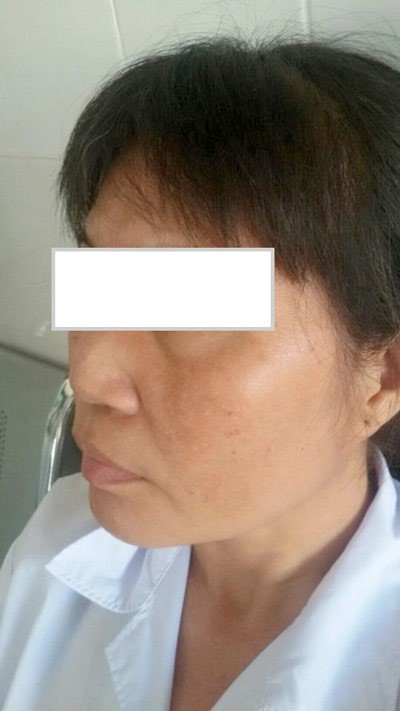 Mũi sưng, lở loét vì tiêm chất làm đẹp - ảnh 1