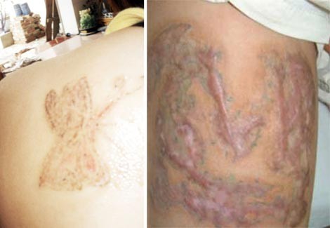 Hãi hùng công nghệ xóa hình xăm, xua vận rủi của dân chơi - ảnh 1