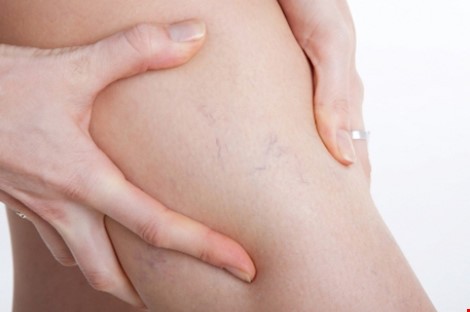 8 điều cần biết về suy tĩnh mạch chân - ảnh 1