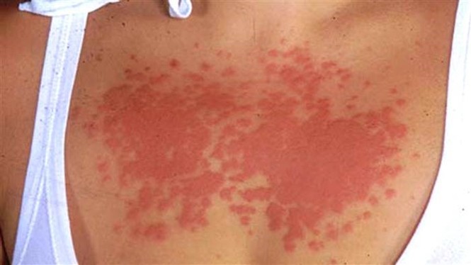Cách xử trí các bệnh dễ gặp mùa hè khi đi biển - ảnh 3