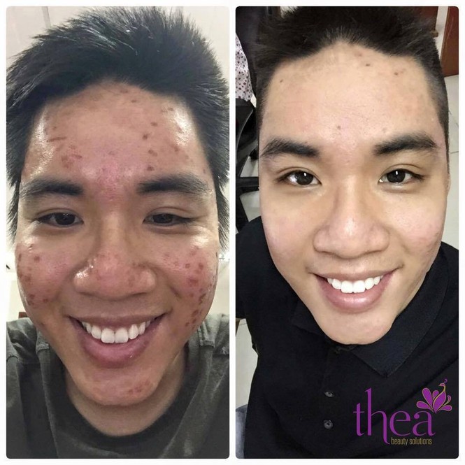 Thea Beauty Solutions ra mắt gói chăm sóc da siêu ưu đãi - ảnh 4