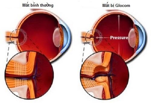 Những bệnh khiến thị lực giảm dần - ảnh 2