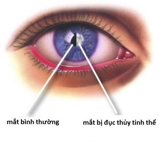 Những bệnh khiến thị lực giảm dần - ảnh 3