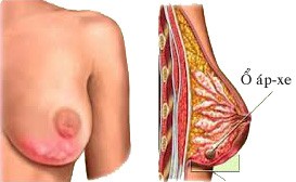 Các bệnh tuyến vú lành tính - ảnh 1