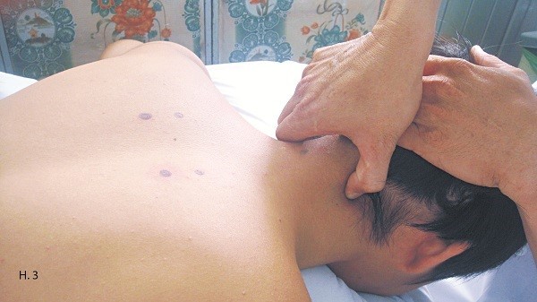 Xoa bóp chữa đau vai gáy hiệu quả - ảnh 3