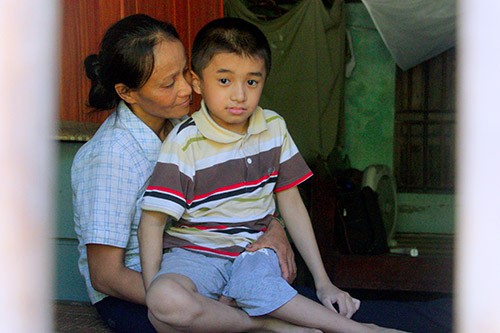 Cậu bé xương thủy tinh, 17 lần gẫy chân mơ thành lập trình viên - ảnh 1