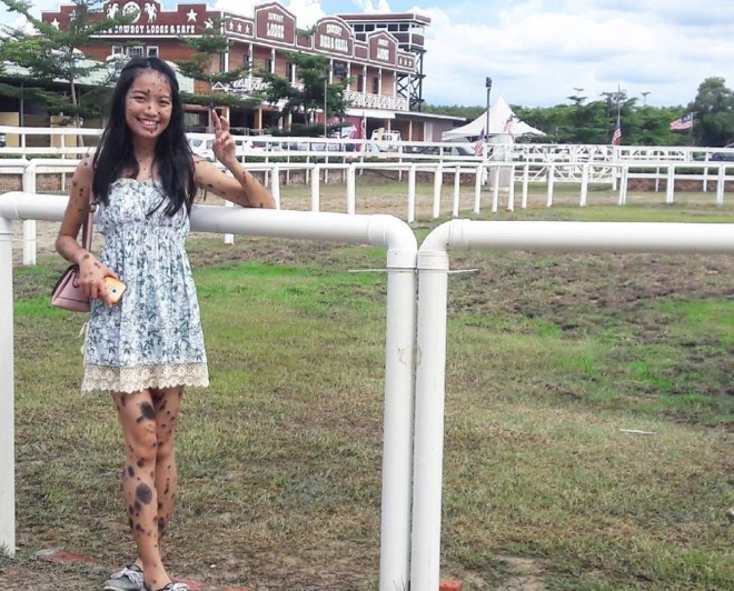 Cô gái có hàng trăm nốt ruồi bất ngờ thi Hoa hậu Hoàn vũ - ảnh 5