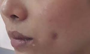 phẫu thuật má lúm đồng tiền - ảnh 1