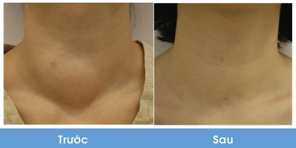 Nhẹ nhàng loại bỏ u tuyến giáp, không cần mổ - ảnh 3