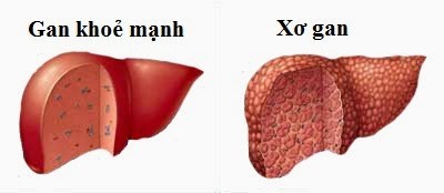 Rượu bia pha ngọt, hại càng thêm sâu