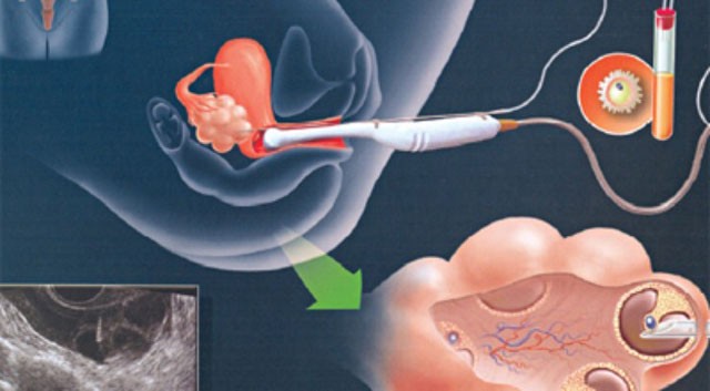 Kích thích buồng trứng là thế nào? - ảnh 1