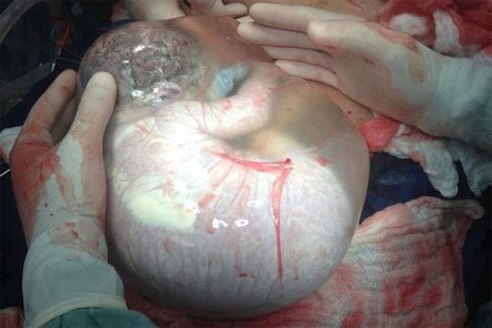 Em bé đã ra khỏi bụng mẹ nhưng được bao bọc trong túi nước ối còn nguyên. Tài liệu y khoa cho biết trong 80.000 ca sinh nở mới có 1 ca như vậy.