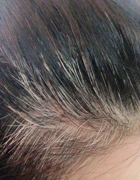 Nhìn vị trí tóc bạc sớm đoán nhiều bệnh nan y - ảnh 7