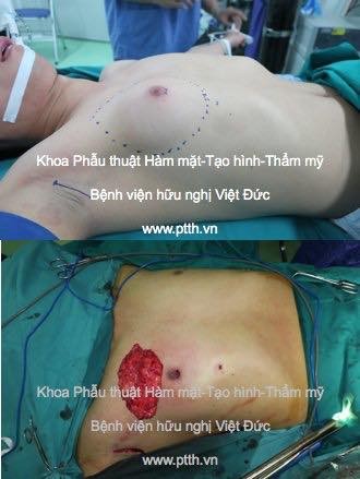 Bác sỹ lý giải trường hợp nam thanh niên có vú to như phụ nữ - ảnh 1