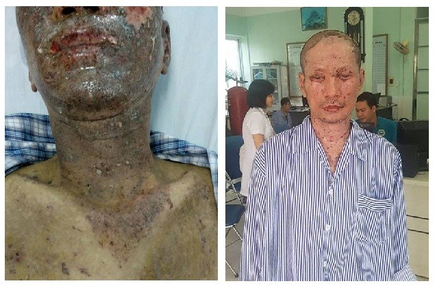 Dùng ô xy cao áp cứu sống ca bỏng nặng do nổ lò gang - ảnh 1
