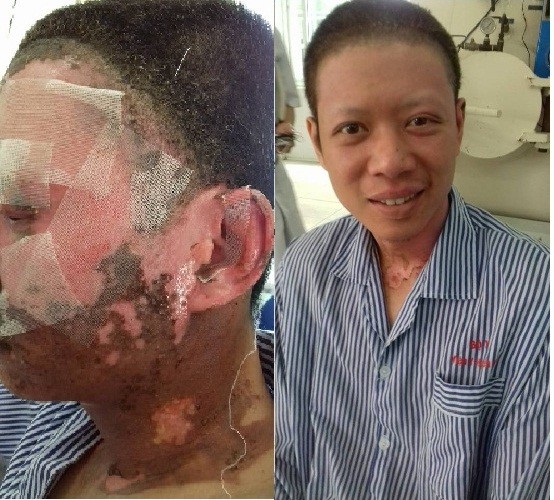 Hàn cắt bằng máy công nghiệp, nam công nhân bỏng lửa nặng - ảnh 1
