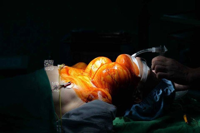 'Giải thoát' cho người phụ nữ 20 năm đeo khối u 4kg giữa cổ - ảnh 1