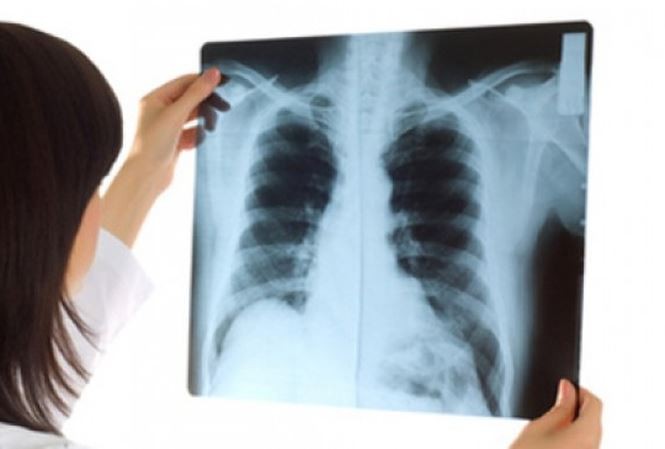 Dấu hiệu sớm căn bệnh 'sát thủ' 21.000 người Việt Nam chết mỗi năm - ảnh 1