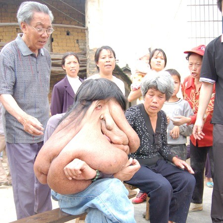 Phẫu thuật khối u nặng 25kg trên mặt - ảnh 1