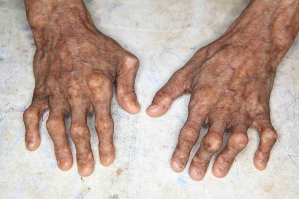 Bé trai 14 tuổi già như ông lão vì mắc bệnh lạ - ảnh 2