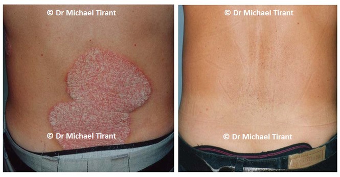 Những điều bạn cần biết về corticoid điều trị bệnh vảy nến - ảnh 1
