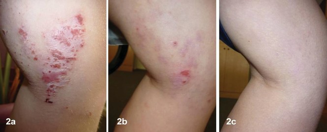Điều trị viêm da dị ứng ở trẻ em bằng phương pháp Dr Michaels thảo dược - ảnh 1