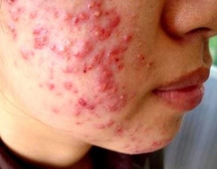 Mụn nhọt, nám da, mệt mỏi – tuyệt đối đừng coi thường - ảnh 2