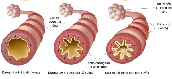 hen suyễn - ảnh 1