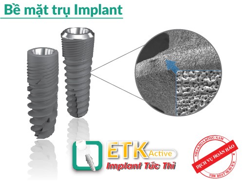 Ưu điểm của việc cấy ghép răng Implant ETK Active - ảnh 2