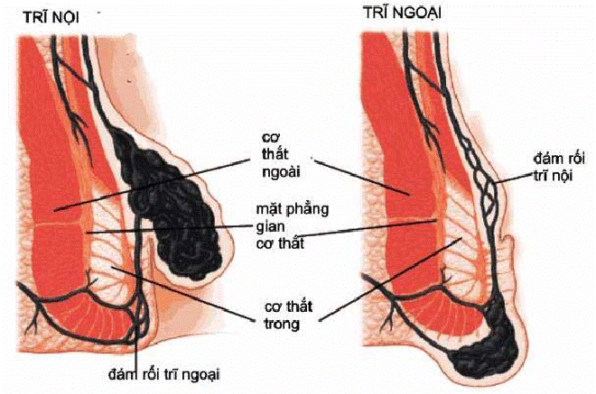 Bênh trĩ - Có thể chữa khỏi không cần phẫu thuật? - ảnh 1