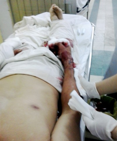 Truy sát kinh hoàng, nhân viên quán ăn bị chém lìa hai tay - ảnh 2
