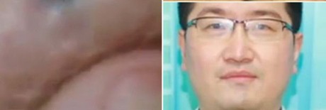 Kinh hãi phát hiện giòi dưới da sau chuyến đi châu Phi - ảnh 1