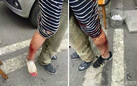 Bảo vệ con, bà mẹ bị chó dữ cắn suýt mất mạng - ảnh 1