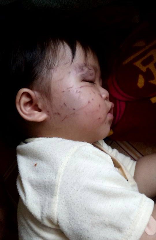 Bé 11 tháng tuổi bị bạn cắn, cào nát mặt ở nhà trẻ - ảnh 2