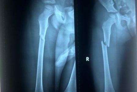 'Vợ chồng' gá nghĩa đánh bé trai 4 tuổi gãy xương đùi - ảnh 1