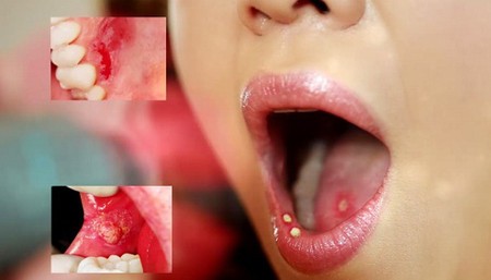 4 bệnh không nguy hiểm nhưng gây khó chịu trong mùa đông - ảnh 2