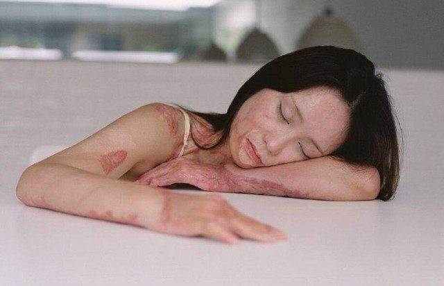 Bộ ảnh vượt qua mặc cảm của cô gái bị thiêu sống - ảnh 3