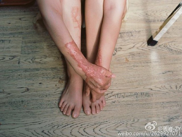 Bộ ảnh vượt qua mặc cảm của cô gái bị thiêu sống - ảnh 4
